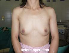 plastic-surgery-breast-augmentation 